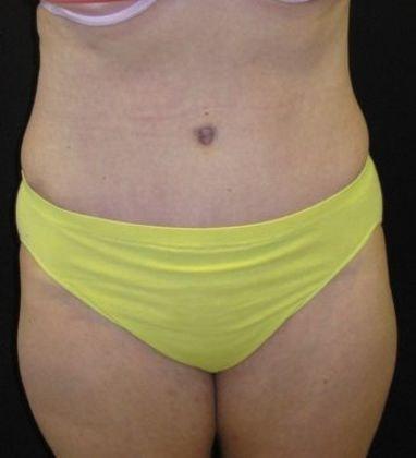 Azita Madjidi, MD tummy tuck after — Houston, TX