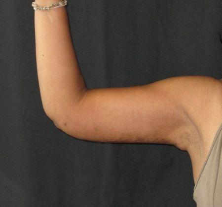 Azita Madjidi, MD arm lift after — Houston, TX
