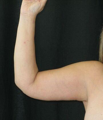 Azita Madjidi, MD arm lift after — Houston, TX