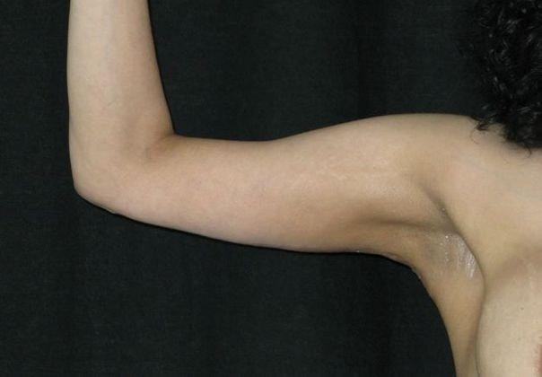 Azita Madjidi, MD arm lift after — Houston, TX