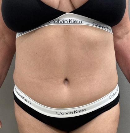 Mini Tummy Tuck after at Cosmetic Surgery Associates in Bethesda, MD