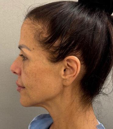 Facelift before at Cosmetic Surgery Associates in Bethesda, MD