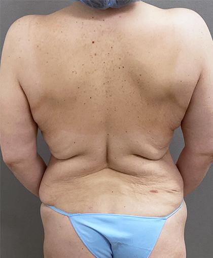 Thigh Lift before at Cosmetic Surgery Associates in Bethesda, MD
