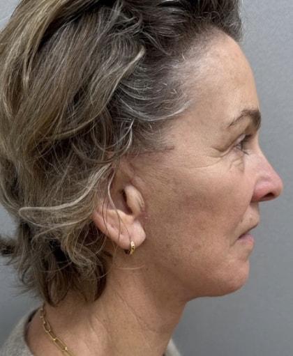 Facelift after at Cosmetic Surgery Associates in Bethesda, MD