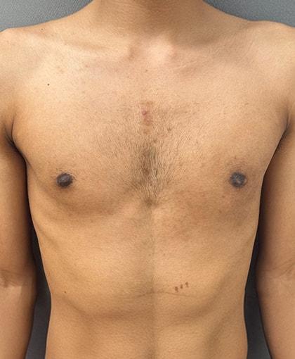 Cosmetic Surgery Associates gynecomastia after — Bethesda, MD