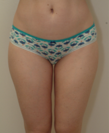 Cosmetic Surgery Associates liposuction after — Bethesda, MD