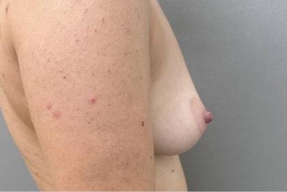 Fat Transfer Breast Augmentation before at Cosmetic Surgery Associates in Bethesda, MD