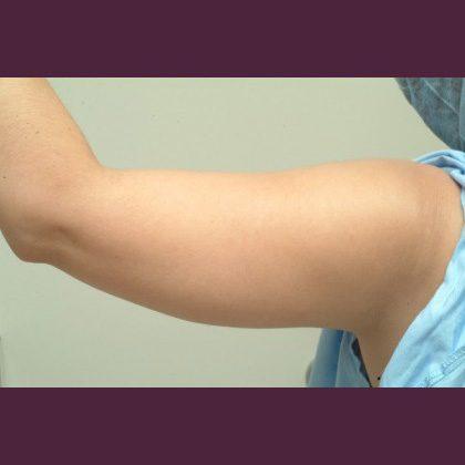 Liposuction before at Cosmetic Surgery Associates in Bethesda, MD