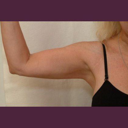 Thigh Lift after at Cosmetic Surgery Associates in Bethesda, MD