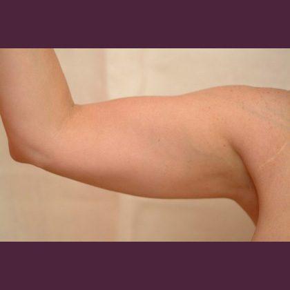 Thigh Lift before at Cosmetic Surgery Associates in Bethesda, MD