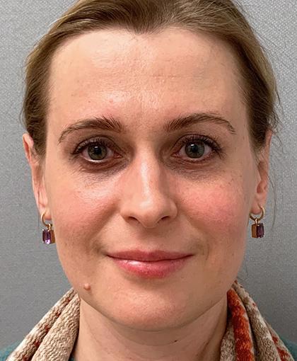 Cosmetic Surgery Associates otoplasty after — Bethesda, MD
