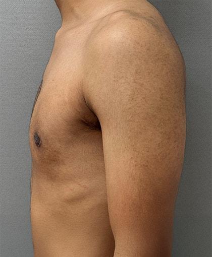 Cosmetic Surgery Associates gynecomastia after — Bethesda, MD