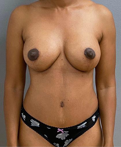 Cosmetic Surgery Associates tummy tuck after — Bethesda, MD