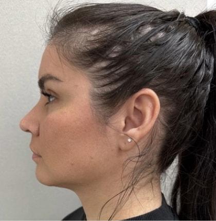Neck Liposuction after at Cosmetic Surgery Associates in Bethesda, MD