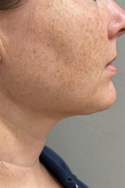 Liposuction after at Cosmetic Surgery Associates in Bethesda, MD