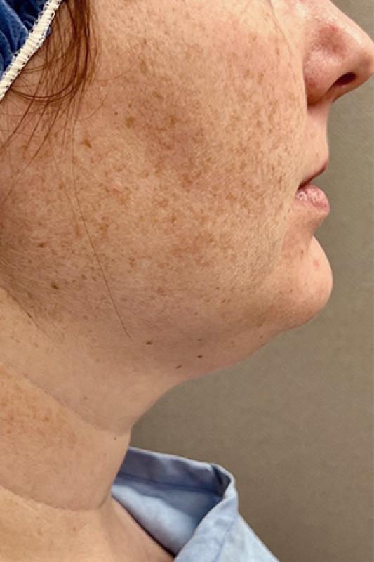 Liposuction before at Cosmetic Surgery Associates in Bethesda, MD