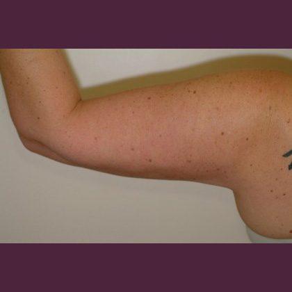 Cosmetic Surgery Associates after — Bethesda, MD
