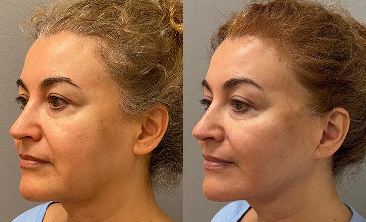 Cosmetic Surgery Associates buccal fat result — Bethesda, MD