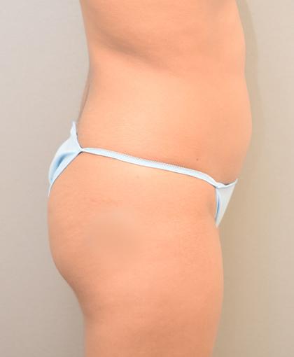 Brazilian Butt Lift before at Cosmetic Surgery Associates in Bethesda, MD