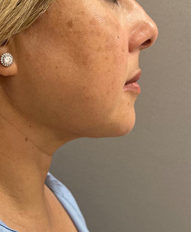 Liposuction after at Cosmetic Surgery Associates in Bethesda, MD
