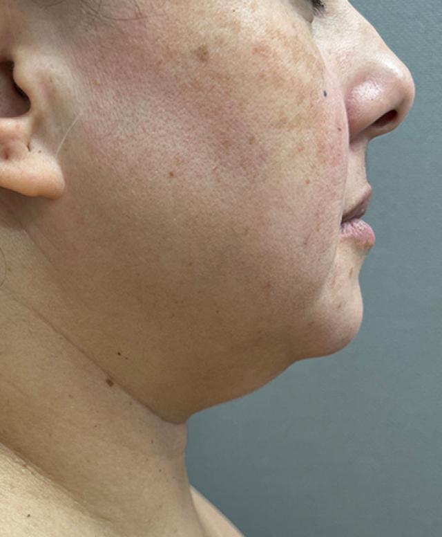 Liposuction before at Cosmetic Surgery Associates in Bethesda, MD