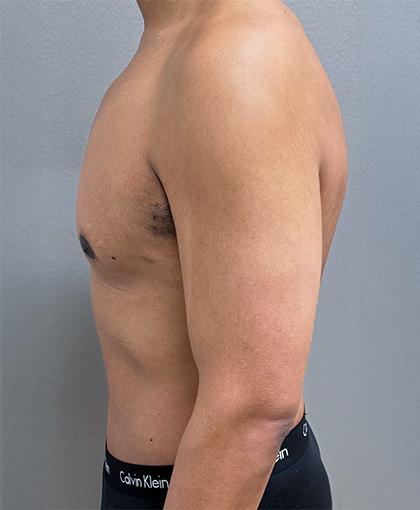 Mini Tummy Tuck after at Cosmetic Surgery Associates in Bethesda, MD