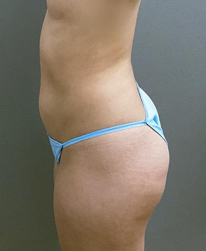 Brazilian Butt Lift before at Cosmetic Surgery Associates in Bethesda, MD