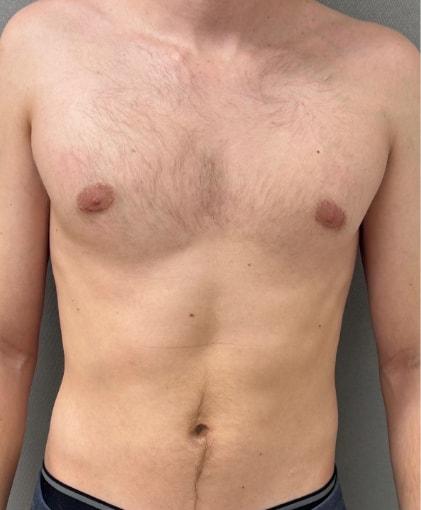Gynecomastia Surgery after at Cosmetic Surgery Associates in Bethesda, MD