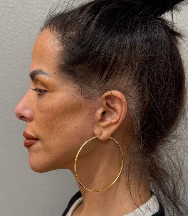Facelift after at Cosmetic Surgery Associates in Bethesda, MD