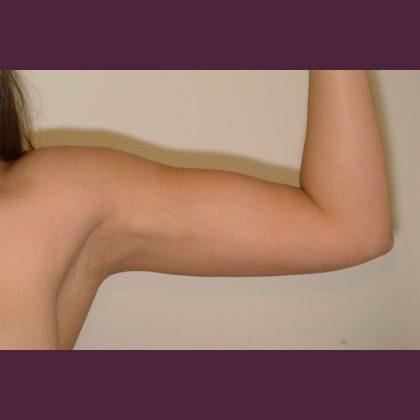 Cosmetic Surgery Associates after — Bethesda, MD