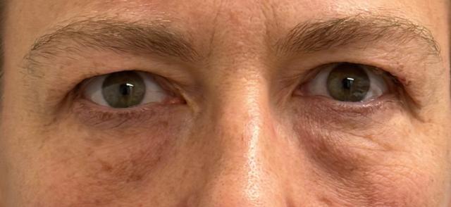 Blepharoplasty before at Cosmetic Surgery Associates in Bethesda, MD