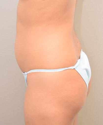 Brazilian Butt Lift before at Cosmetic Surgery Associates in Bethesda, MD