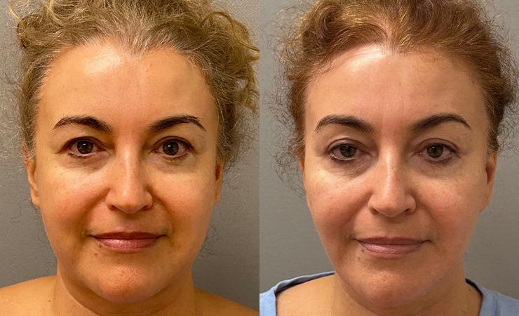 Cosmetic Surgery Associates buccal fat result — Bethesda, MD