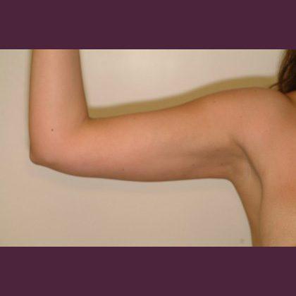 Cosmetic Surgery Associates after — Bethesda, MD