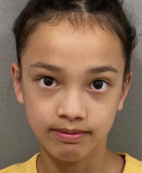 Cosmetic Surgery Associates otoplasty after — Bethesda, MD