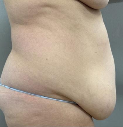 Mini Tummy Tuck before at Cosmetic Surgery Associates in Bethesda, MD