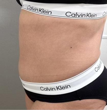 Cosmetic Surgery Associates tummy tuck after — Bethesda, MD