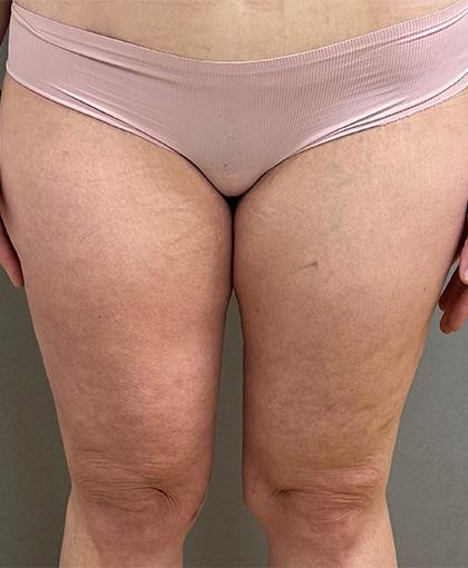 Cosmetic Surgery Associates thigh lift after — Bethesda, MD