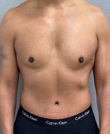 Mini Tummy Tuck after at Cosmetic Surgery Associates in Bethesda, MD