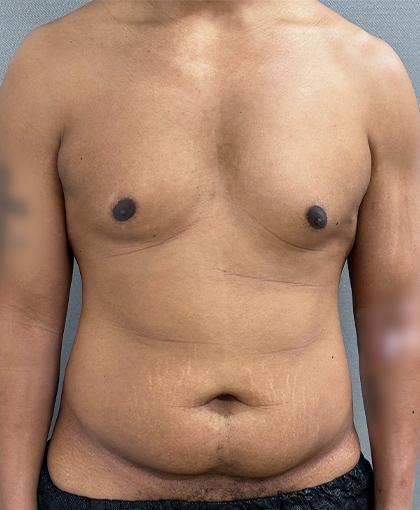 Mini Tummy Tuck before at Cosmetic Surgery Associates in Bethesda, MD