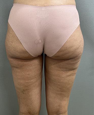 Liposuction after at Cosmetic Surgery Associates in Bethesda, MD
