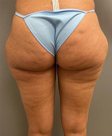 Liposuction before at Cosmetic Surgery Associates in Bethesda, MD