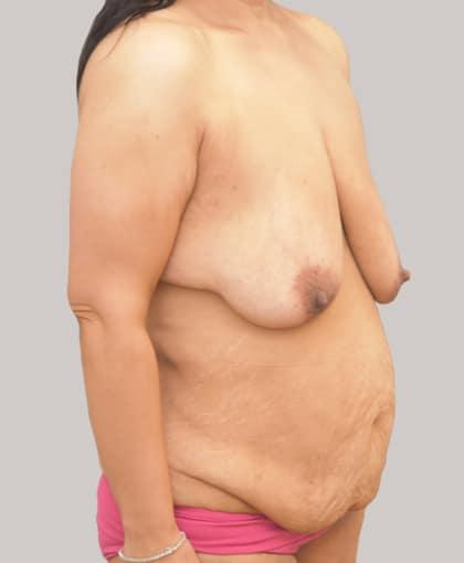 Mini Tummy Tuck before at Cosmetic Surgery Associates in Bethesda, MD