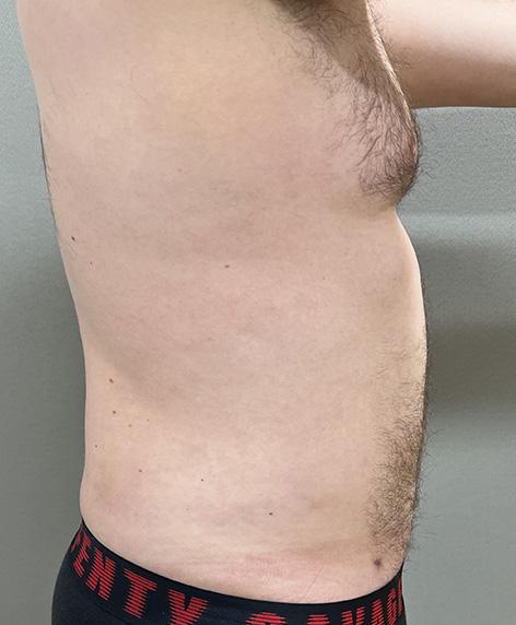 Liposuction after at Cosmetic Surgery Associates in Bethesda, MD