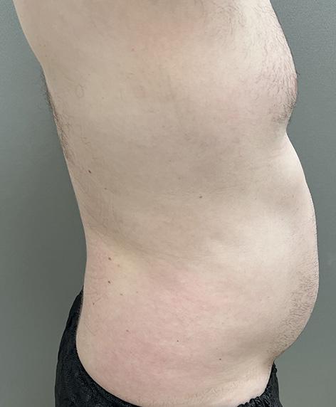 Liposuction before at Cosmetic Surgery Associates in Bethesda, MD