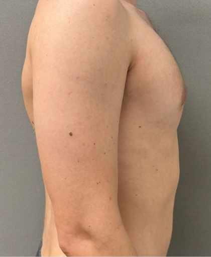 Gynecomastia Surgery after at Cosmetic Surgery Associates in Bethesda, MD