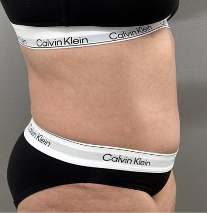Cosmetic Surgery Associates tummy tuck after — Bethesda, MD