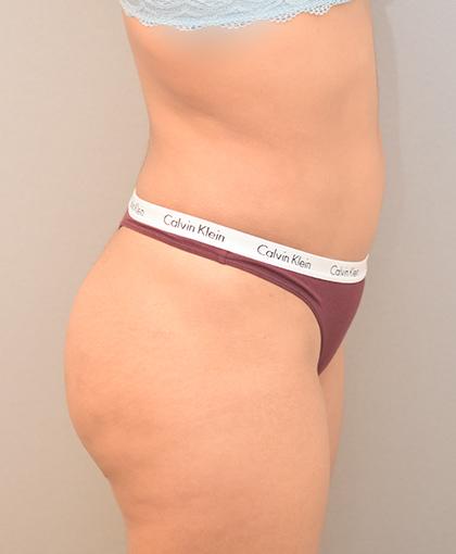 Brazilian Butt Lift after at Cosmetic Surgery Associates in Bethesda, MD
