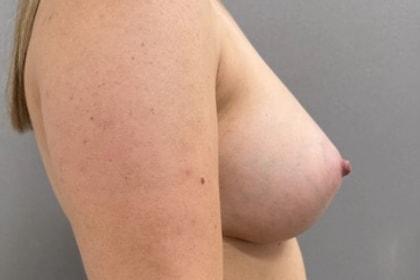 Fat Transfer Breast Augmentation after at Cosmetic Surgery Associates in Bethesda, MD
