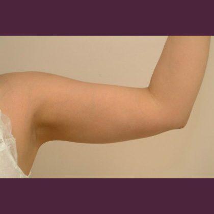 Cosmetic Surgery Associates after — Bethesda, MD